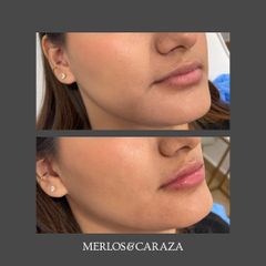 Aumento de labios - Merlos & Caraza