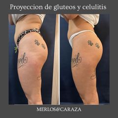 Celulitis - Merlos & Caraza