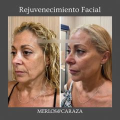 Rejuvenecimiento Facial - Merlos & Caraza