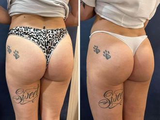 Celulitis antes y después - 857796