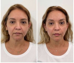 Rellenos faciales - Merlos & Caraza