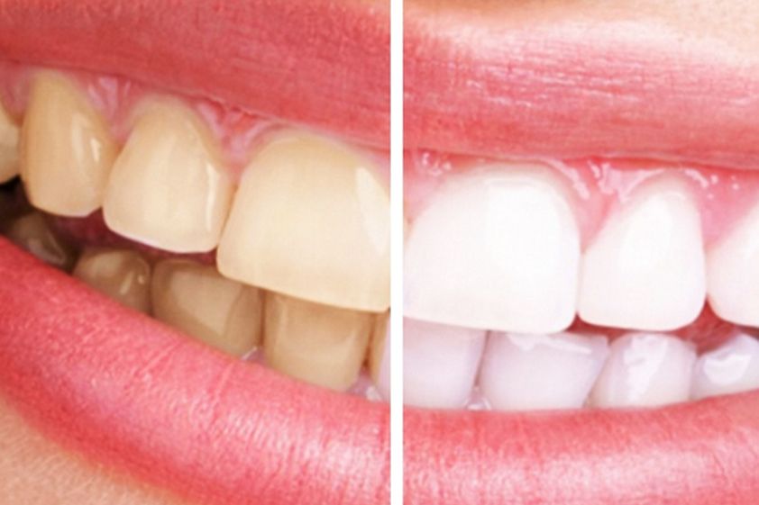 Blanqueamiento dental antes y después - 541397