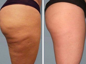 Mesoterapia - 551368