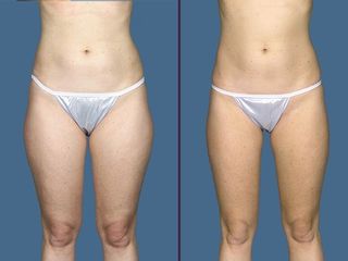 Liposuccion