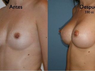 Antes y despues de aumento de senos
