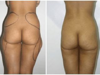 Antes y despues de liposuccion
