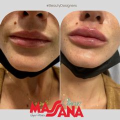 Aumento de labios - Clínicas Massana