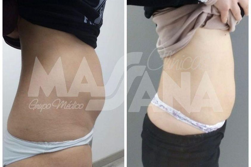 Criolipólisis antes y después - 826521