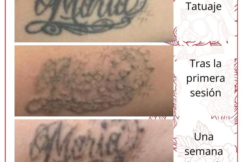 Eliminación de tatuajes antes y después - 839230