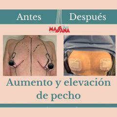 Aumento y elevación de pecho
