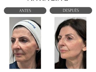 Eliminación arrugas antes y después - 874495