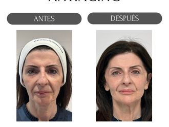 Eliminación arrugas antes y después - 874496