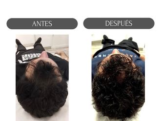 Tratamiento capilar antes y después - 874497
