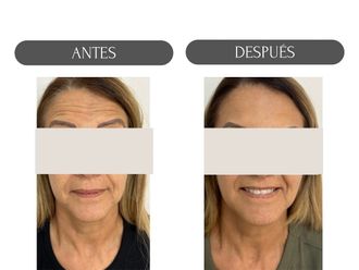Rejuvenecimiento facial antes y después - 874498