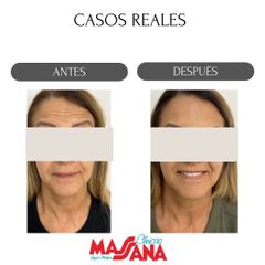 Rejuvenecimiento facial