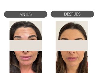 Rejuvenecimiento facial antes y después - 874499