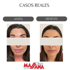 Rejuvenecimiento facial