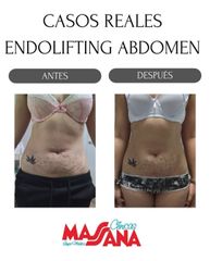 Endolifting - Grupo Médico Clínicas Massana