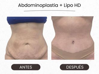 Abdominoplastia antes y después - 880153