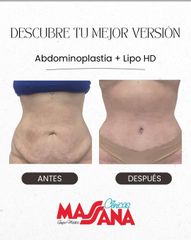 Abdominoplastia - Grupo Médico Clínicas Massana