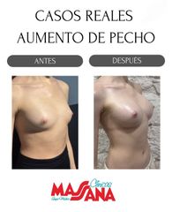 Aumento de pecho - Grupo Médico Clínicas Massana