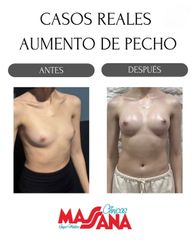 Aumento de pecho - Grupo Médico Clínicas Massana