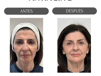 Rejuvenecimiento facial antes y después - 880156