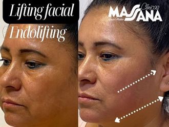 Lifting antes y después - 880157