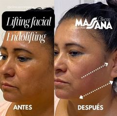 Lifting Facial - Grupo Médico Clínicas Massana