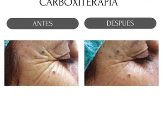 Carboxiterapia antes y después - 880158