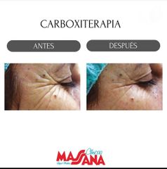 Carboxiterapia - Grupo Médico Clínicas Massana