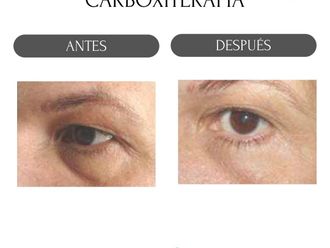 Carboxiterapia antes y después - 880159