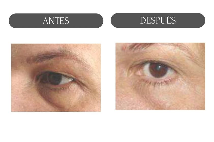 Carboxiterapia antes y después - 880159