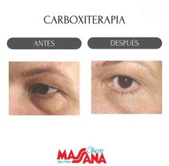 Carboxiterapia - Grupo Médico Clínicas Massana