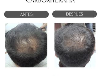 Carboxiterapia antes y después - 880160