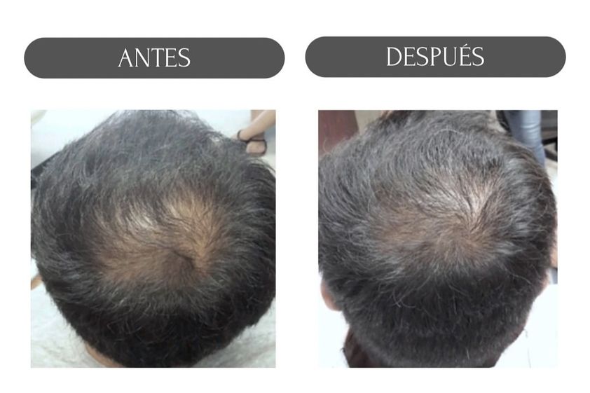 Carboxiterapia antes y después - 880160