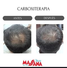Carboxiterapia - Grupo Médico Clínicas Massana