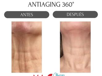 Rejuvenecimiento facial antes y después - 880161