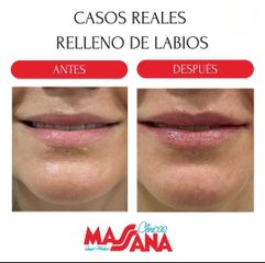 Aumento de labios - Grupo Médico Clínicas Massana