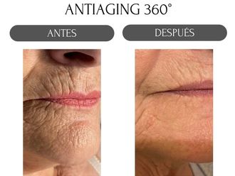 Rejuvenecimiento facial antes y después - 880163