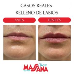 Aumento de labios - Grupo Médico Clínicas Massana