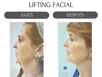 Lifting antes y después - 880184
