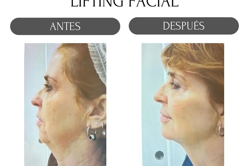 Lifting antes y después - 880184
