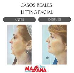 Lifting Facial - Grupo Médico Clínicas Massana