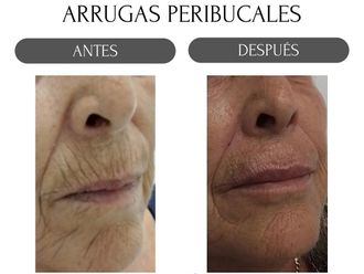 Eliminación arrugas antes y después - 880185