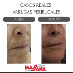 Eliminación de arrugas - Grupo Médico Clínicas Massana