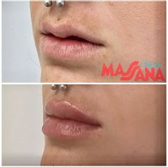 Aumento de labios - Grupo Médico Clínicas Massana