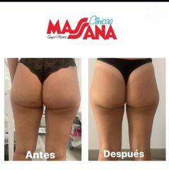 Aumento de glúteos - Grupo Médico Clínicas Massana