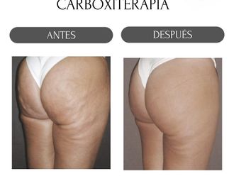 Carboxiterapia antes y después - 880188