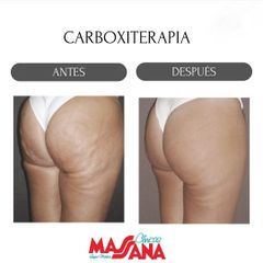 Carboxiterapia - Grupo Médico Clínicas Massana